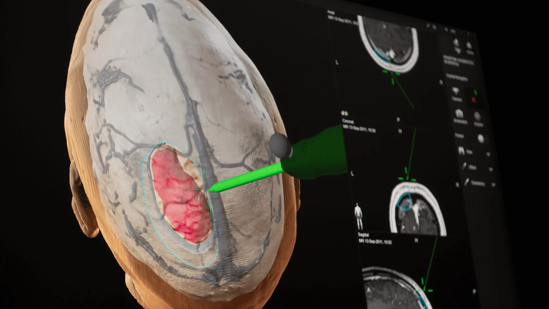 Brainlab Cranial Navigation - Virtual Scalpel Simulation