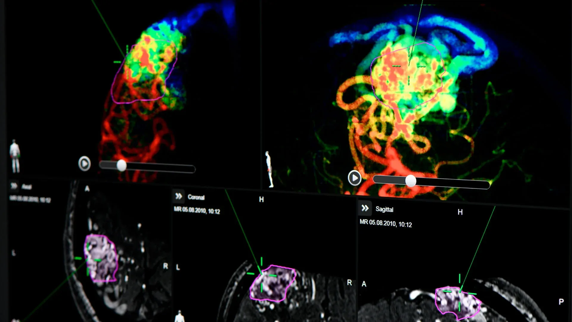 Brainlab Vascular Navigation - Color Intensity Projection
