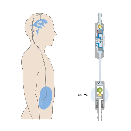 proGAV 2.0 Vertical Position Illustration