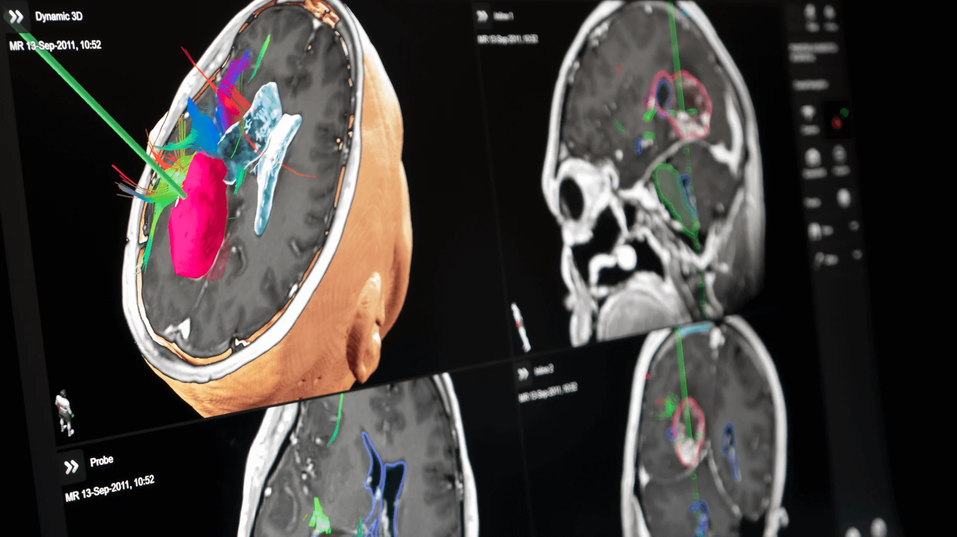 Z-touch and Softouch Registration in Brainlab Navigation